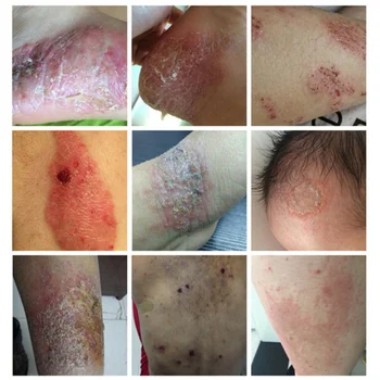 Tratament Psoriazis, Eczeme, Mancarimi De Îngrijire A Pielii Pe Bază De Plante Crema De Corp Crema Psoriazis Dermatite Mâncărime Reparații Eczematoid Unguent