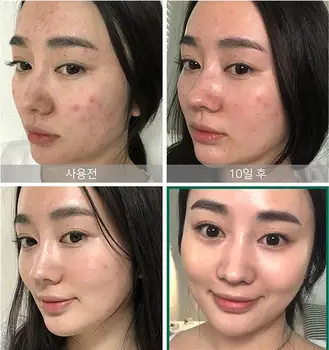 CEVA DE KM AHA, BHA PHA 30 de Zile Miracol Toner 150ml Coreea de Fata Ser Tratament pentru Acnee Crema Cicatrice, Pete Remover Faciale Esența