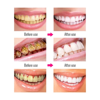 OMYLADY Albirea Dintilor Esența Praf de Igienă Orală Curățare Ser Indeparteaza Placa Petele de Albire a Dintilor Dentare, Instrumente Dentare de Îngrijire
