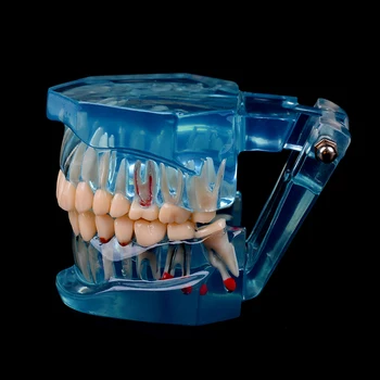 Noul Implant Dentar Boli De Dinți Model Cu Restaurarea Podului Dinte La Dentist Pentru Știința Medicală Dentară Boala De Predare Studiu