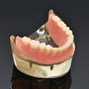 Dentare Supraprotezarea pe Dinți Model Detașabil Interior Mandibular Inferior Dinți Modelul Mandibular cu Implant de Dinte de Predare Studiu