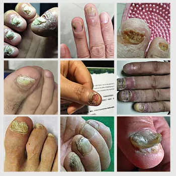 LANBENA Îngrijirea Unghiilor Gel Tratament Fungice Îndepărtarea Picior Ciuperca Unghiilor Anti Infectie Paronichie Onicomicoza Esența Mână, Picior de Îngrijire