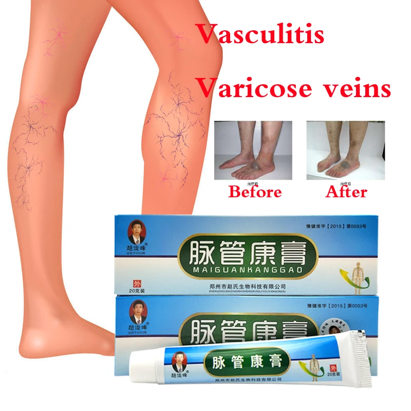 complex de exerciii de la picioarele varicoase farmacii cumpara carucioare de la varicoza
