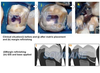 Dentare Tofflemire Matricea de Adânc Marja de Altitudine Mare Curbură Matrici de Fixare a Secțiunii Conturat Matrice dentare Material