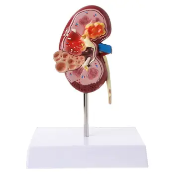 Viața Dimensiunea Umană Rinichi Bolnave Model Anatomice Anatomie Bolnave Patologice Piatra Organ material Didactic 634B