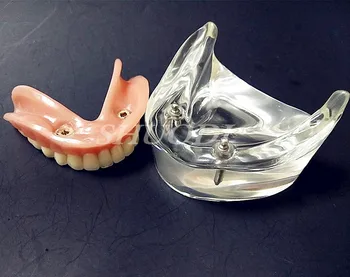 Clinica Decor Dentare Overdenture Interior Mandibular Inferior cu 2 Implant Restaurarea Dintilor Studiu Preda Model