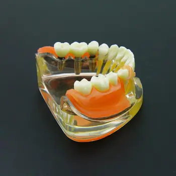 Implant Dentar Restaurarea Dintilor Model Detașabil Punte Dentară Demo #6006